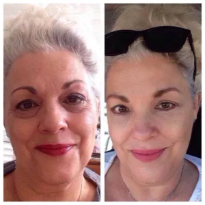 Before and After